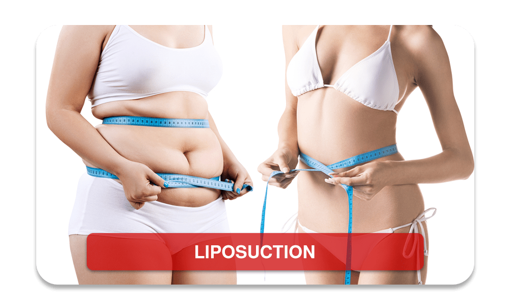 LIPOSUCTION