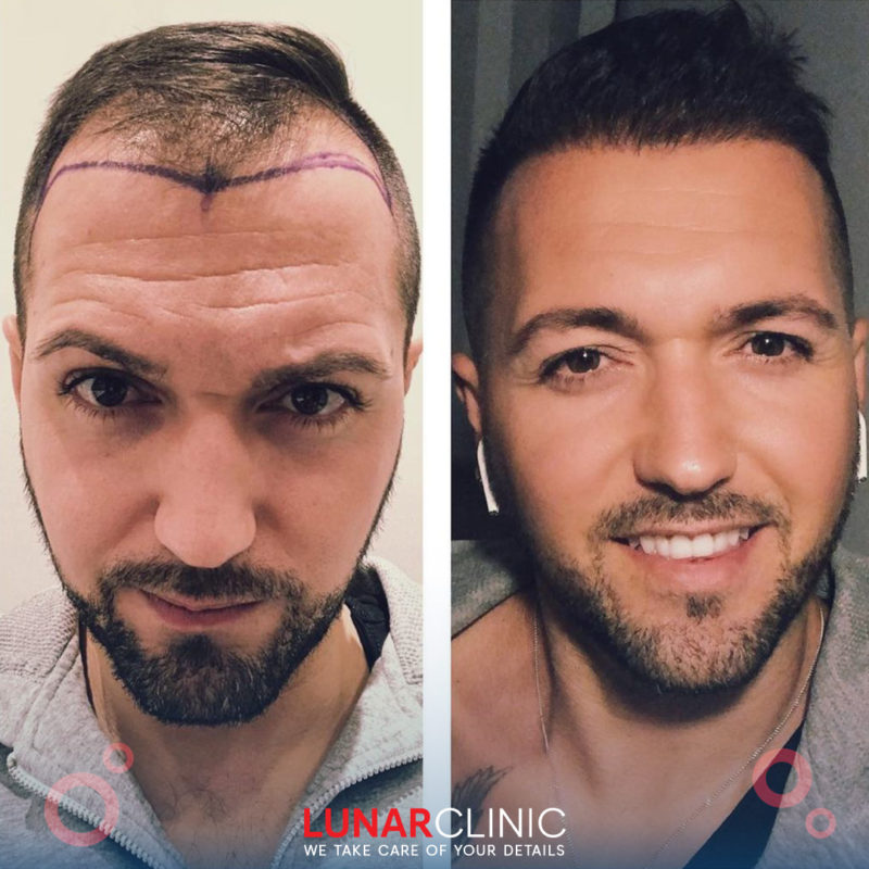 Hair Treatments lunarclinic (18)
