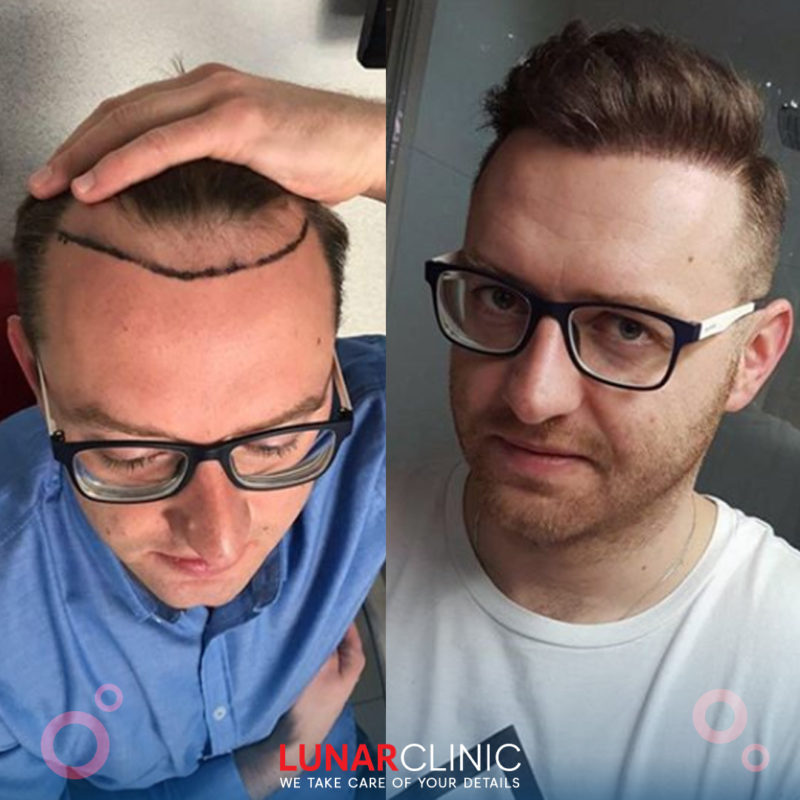 Hair Treatments lunarclinic (2)
