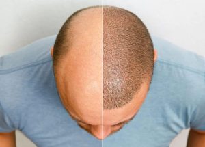 Hair Transplant